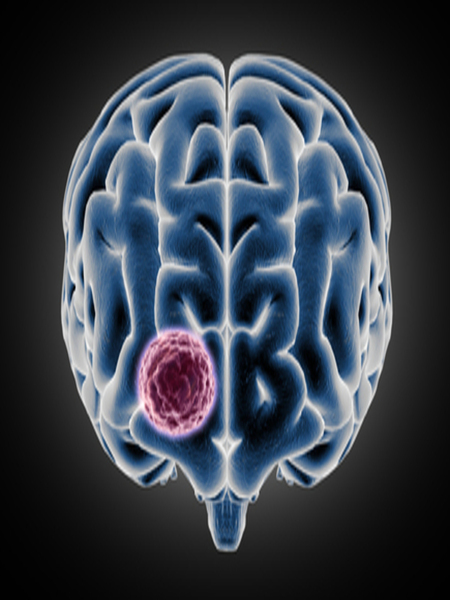brain highlighting tumour symptoms